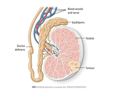 cancer_testicular_nodul_testicul