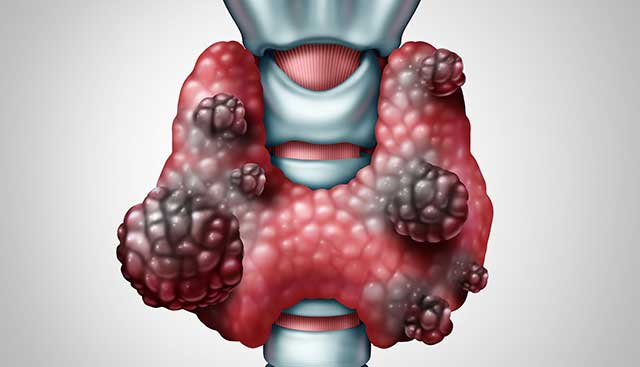 Articole/gusa multinodulara OncoFort